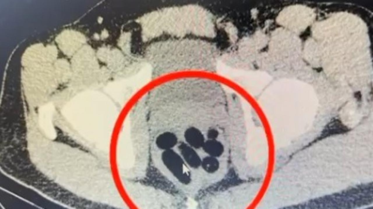 kayseride uyusturucu operasyonu midesinden cikan soke etti CWUyOvyw.jpg